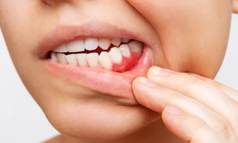 Gum Disease Treatment
